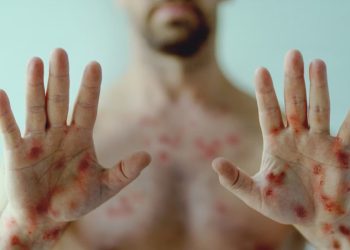 MG tem 3 casos confirmados de mpox em 2026